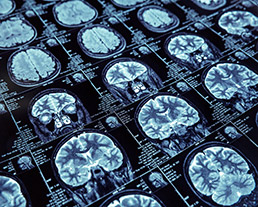 Alzheimer : critique des affirmations alarmistes ou remèdes miracles